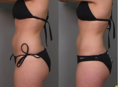 MASAZH SLIMING - SLIMING MASSAGE