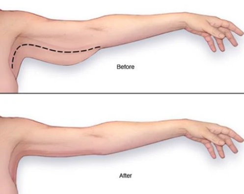 BENDAZH TRUPI -BANDAGE CORPS