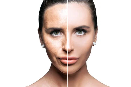 Micro-needling with Morpheus 8