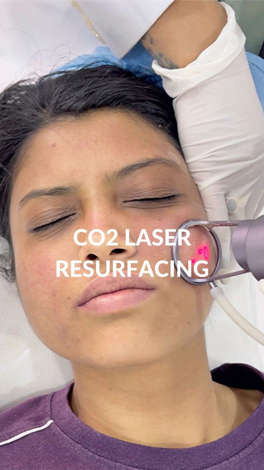 Lazer CO2