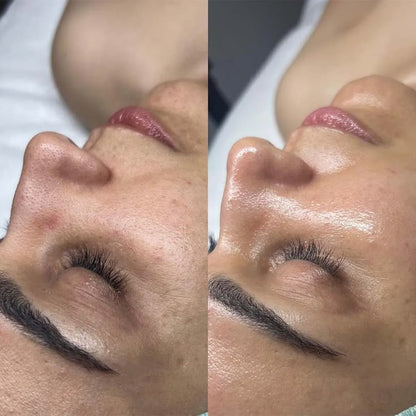 Hidro-facial Candela