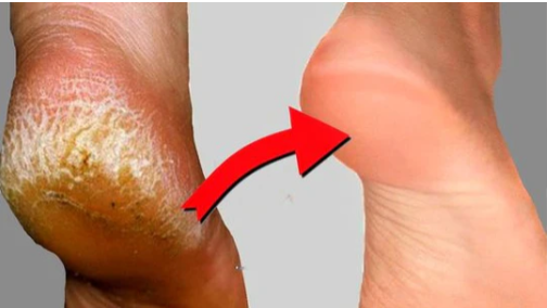 TRAJTIMI I THELLE ME MJETE MJEKESORE + ESTETIK [trajtimi i thelle i kembes me myk ,kallo dhe mish ne thua] - MEDICAL + AESTHETIC TREATMENT FOOT [with callus mold and flesh in the claw]