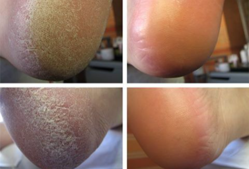 TRAJTIMI I THELLE ME MJETE MJEKESORE + ESTETIK [trajtimi i thelle i kembes me myk ,kallo dhe mish ne thua] - MEDICAL + AESTHETIC TREATMENT FOOT [with callus mold and flesh in the claw]